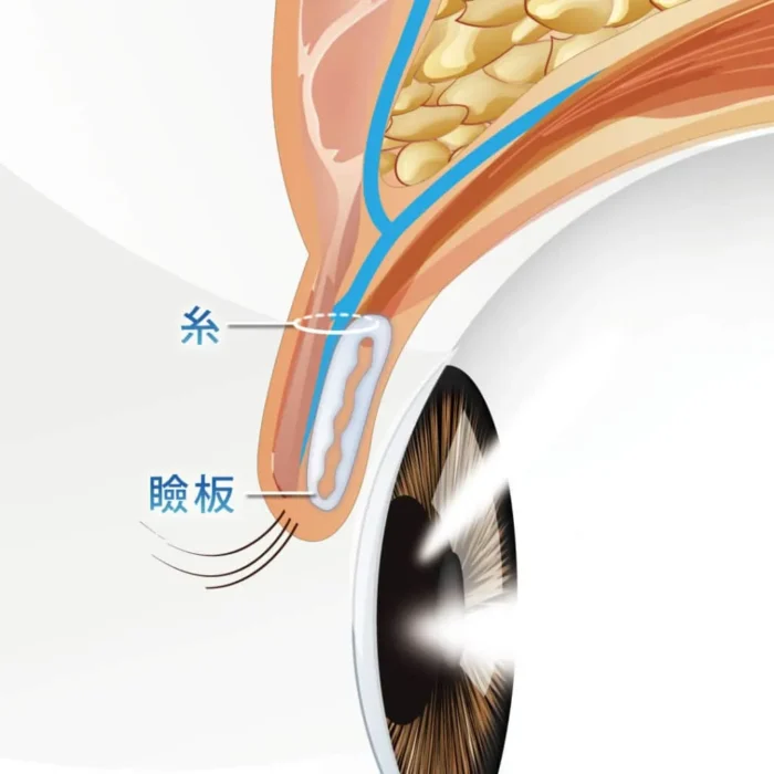 二重埋没_瞼板法_図解