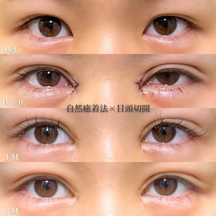 二重埋没_自然癒着法＋目頭切開（劉奕陽）