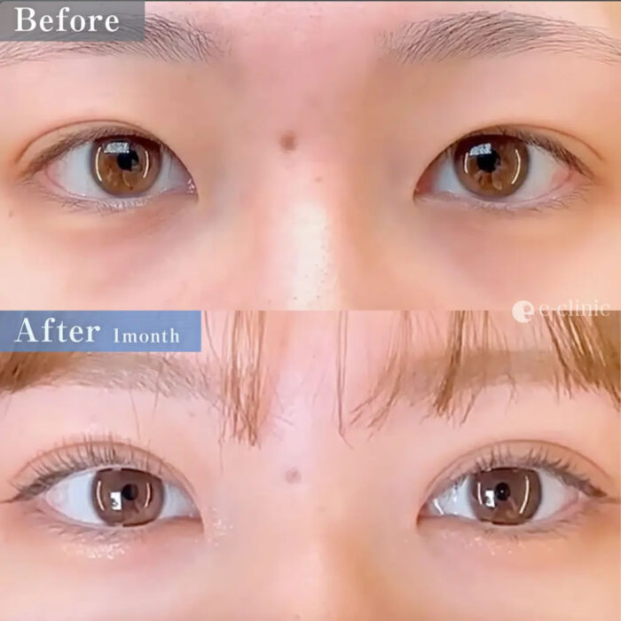 二重埋没法 クイックループダブル4点裏留めの症例写真