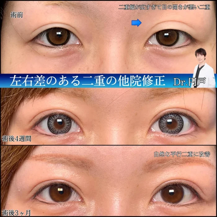 二重整形_二重全切開と眼瞼下垂の他院修正（円戸）