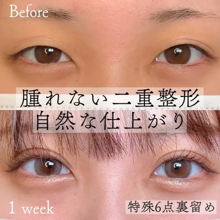 二重整形_埋没法_特殊6点裏留め（名医の張田修平医師が執刀）