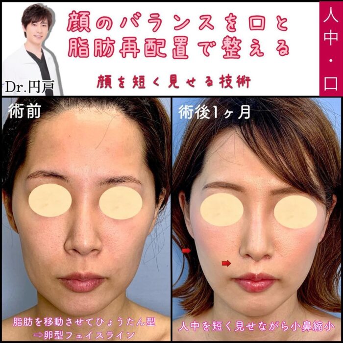 人中短縮と糸リフトの症例