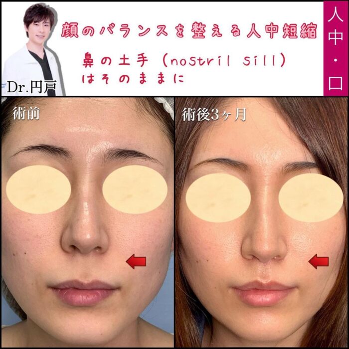 人中短縮の症例