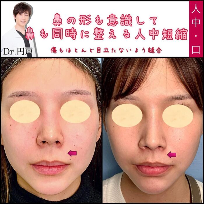 人中短縮を受けた20女性の症例写真