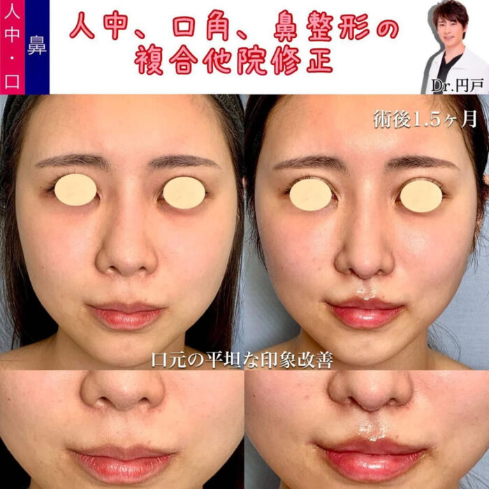 口角挙上と人中短縮と外側人中短縮の傷痕修正と鼻中隔延長の他院修正の症例写真