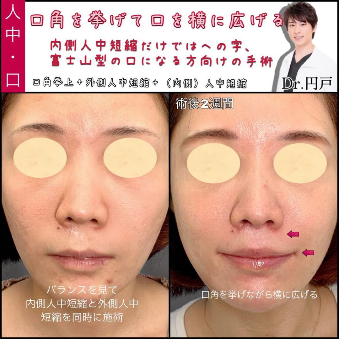 口角挙上と外側人中短縮と内側人中短縮の症例
