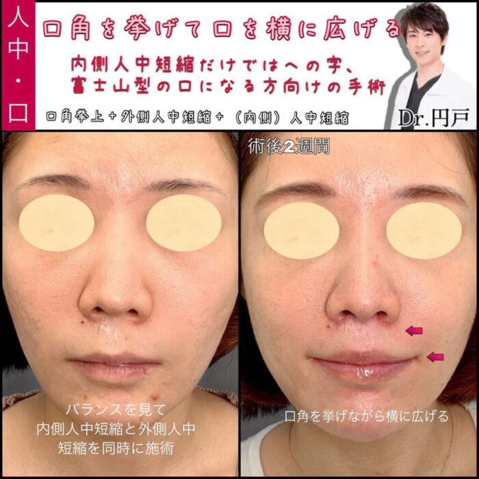 口角挙上と外側人中短縮と内側人中短縮を同時に行った2週間後の症例