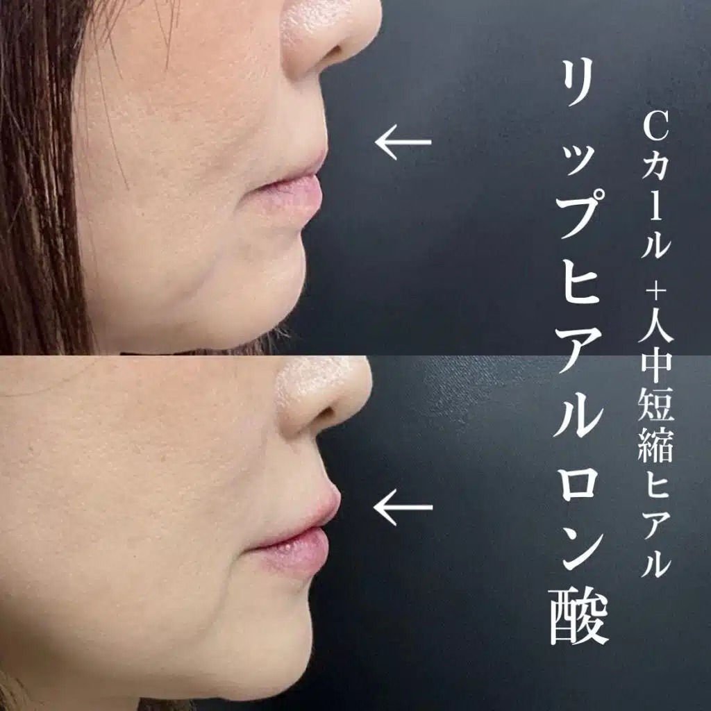 唇のヒアルロン酸の症例写真