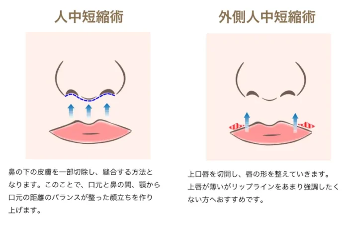 外側人中短縮術と人中短縮術の違いの図解