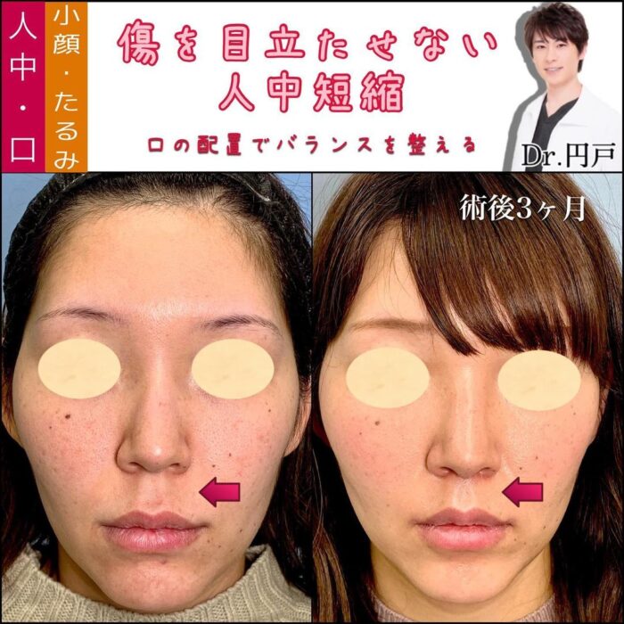 女性の人中短縮の症例写真