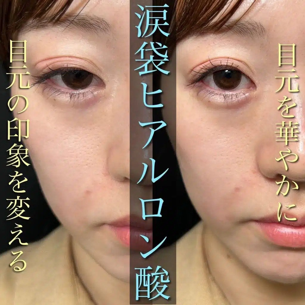 涙袋のヒアルロン酸の症例写真