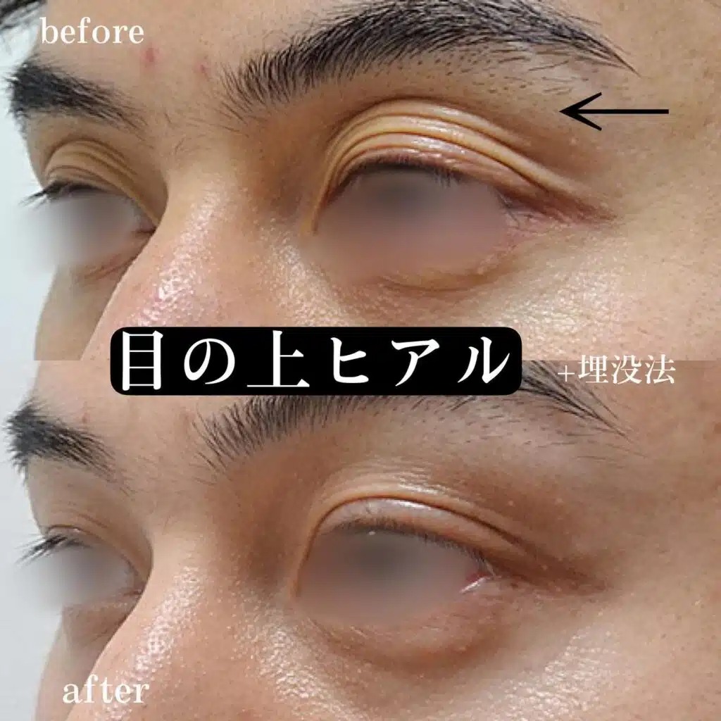 目の上のヒアルロン酸の症例写真