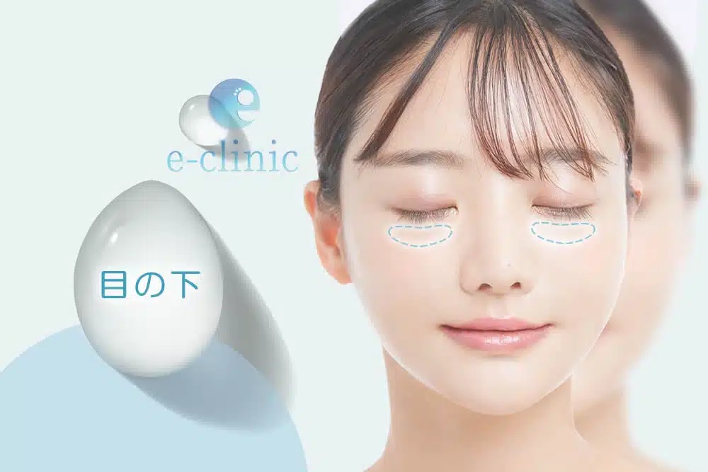 目の下のヒアルロン酸のイメージ