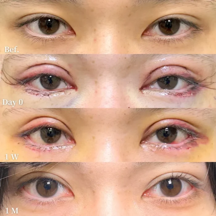 目フル（全切開二重＋目尻切開＋タレ目形成）のダウンタイム経過