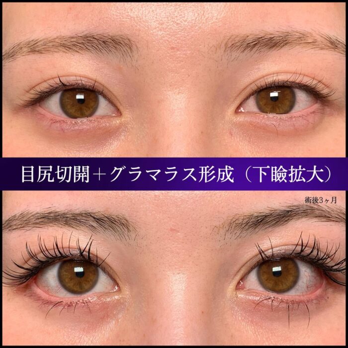目尻切開とタレ目形成の症例写真 (7)