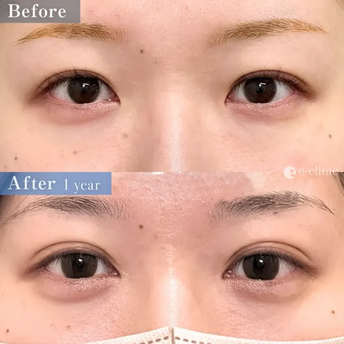 目頭切開＋二重整形_自然癒着法＋涙袋ヒアルロン酸（名医の八木良太）（200）