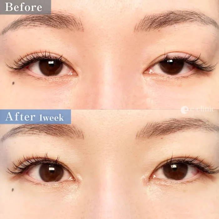 目頭形成（目頭切開の他院修正）（円戸望）（198）