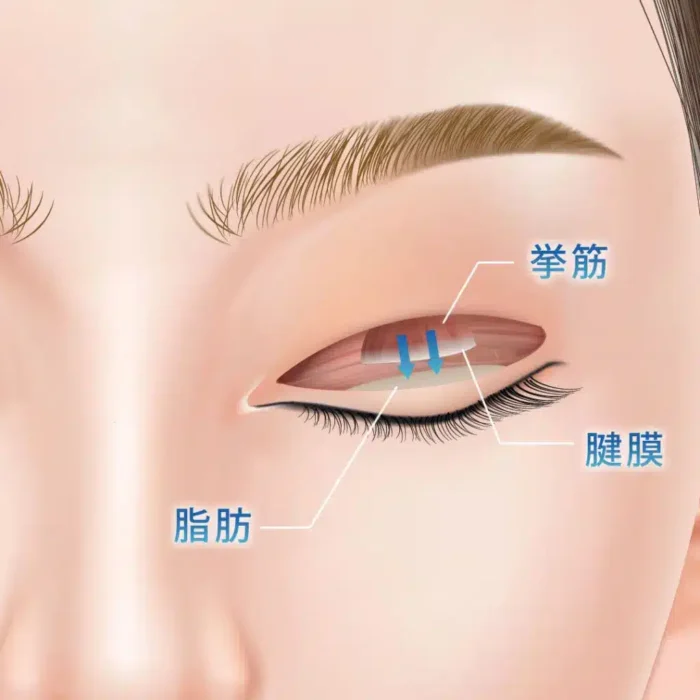 眼瞼下垂_挙筋腱膜前転法の図解