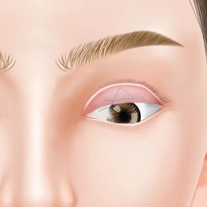 眼瞼下垂_非切開法（ミュラータッキング法）_図解