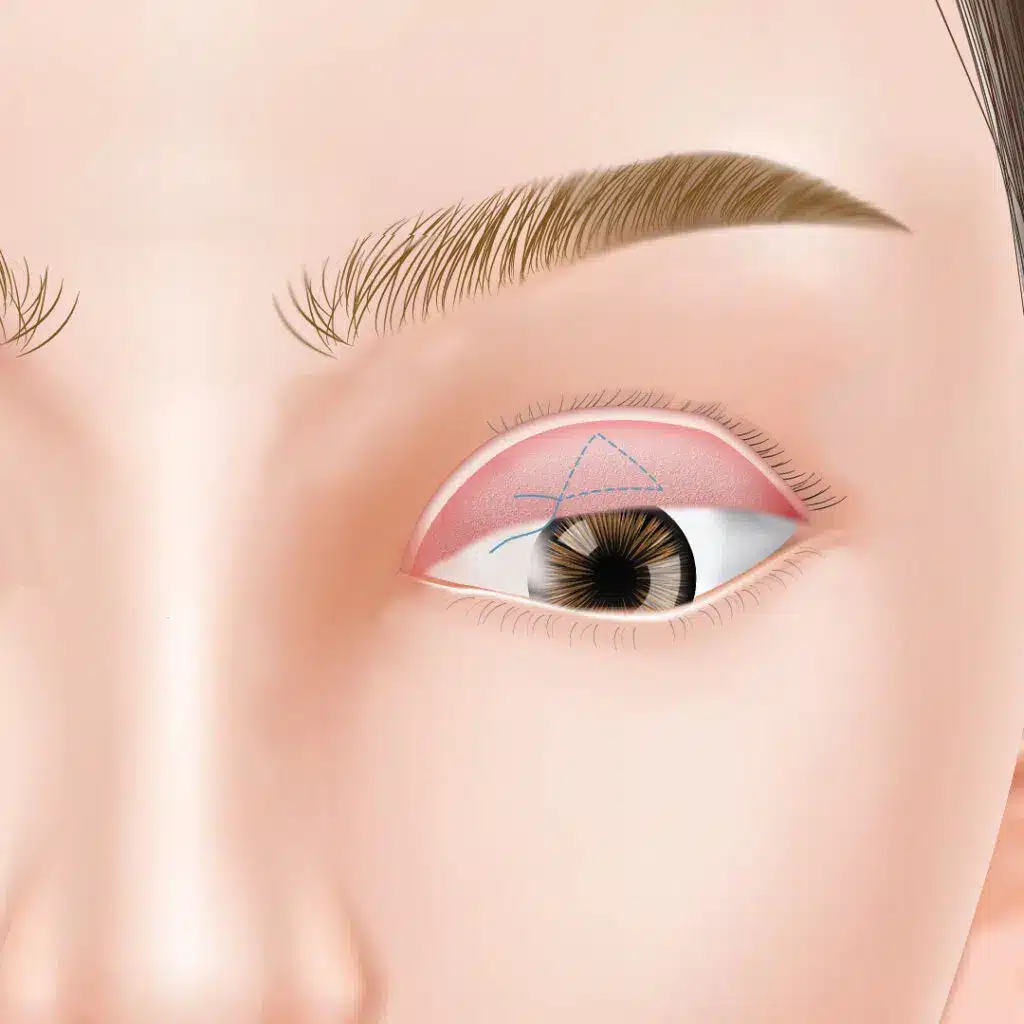 眼瞼下垂_非切開法（ミュラータッキング法）_図解