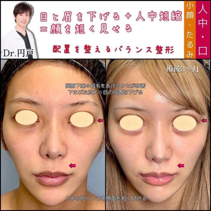 眼瞼下垂と下瞼拡大と人中短縮の症例写真