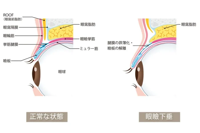 眼瞼下垂の図解