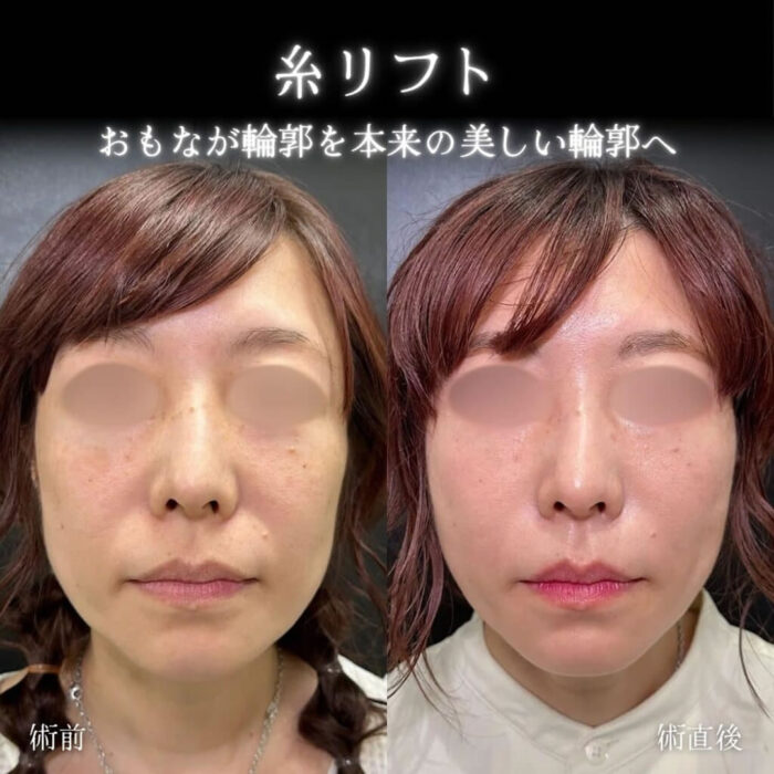 糸リフトの症例