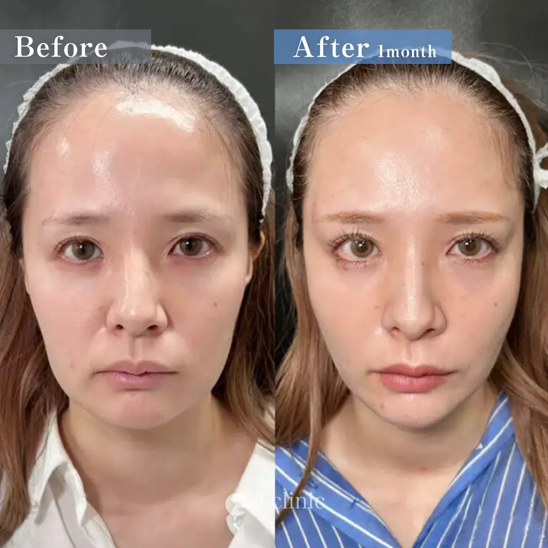 糸リフトでフェイスラインが綺麗になった症例写真