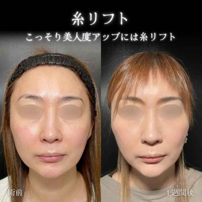 糸リフトの症例写真 (1)