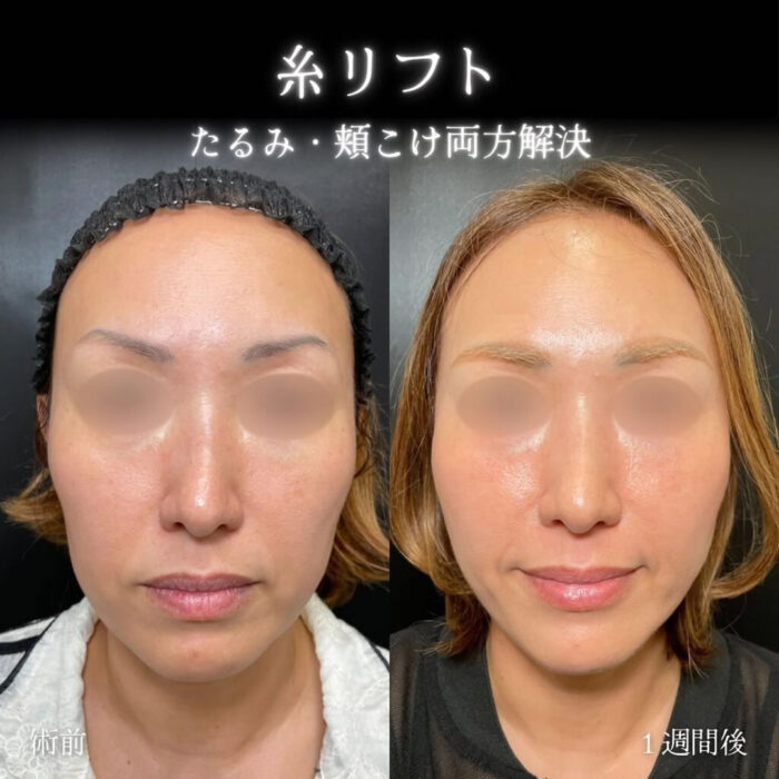 糸リフトの症例写真 (5)