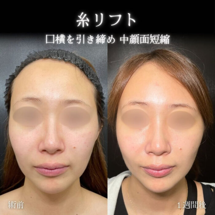 糸リフトの症例写真 (6)