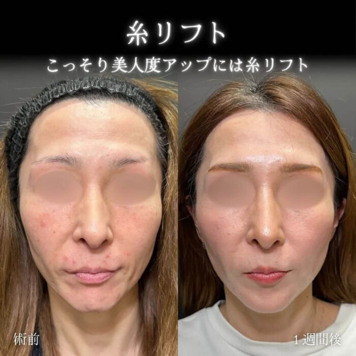 糸リフトの症例写真