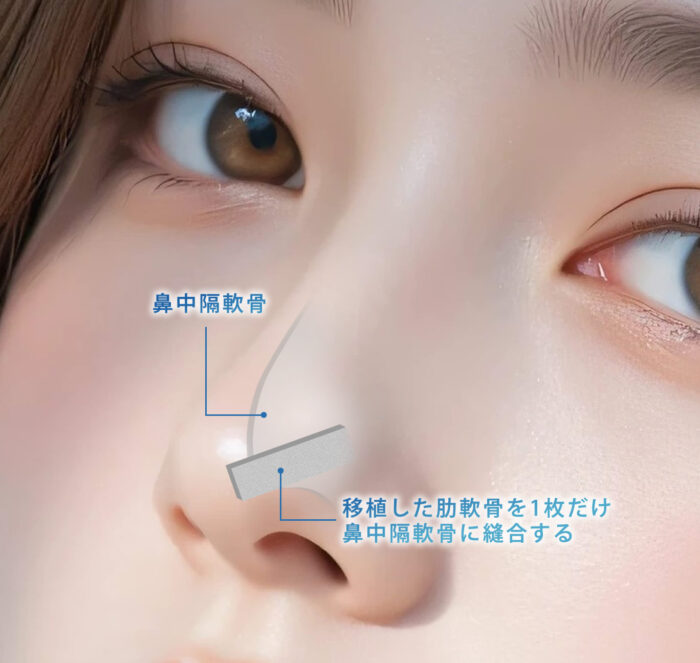 肋軟骨を１枚だけ移植して鼻先を高くした図解