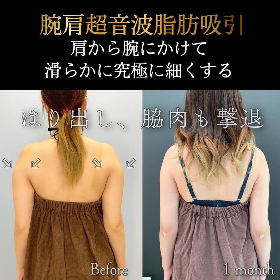 腕肩の超音波脂肪吸引の症例写真