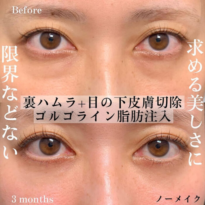 裏ハムラ法と目の下の皮膚切開と脂肪注入の症例写真