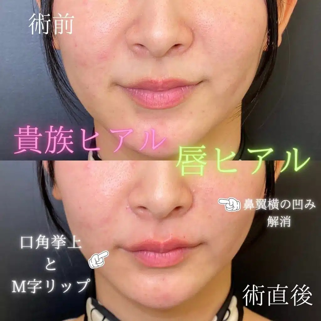 貴族フィラーと唇のヒアルロン酸の症例写真