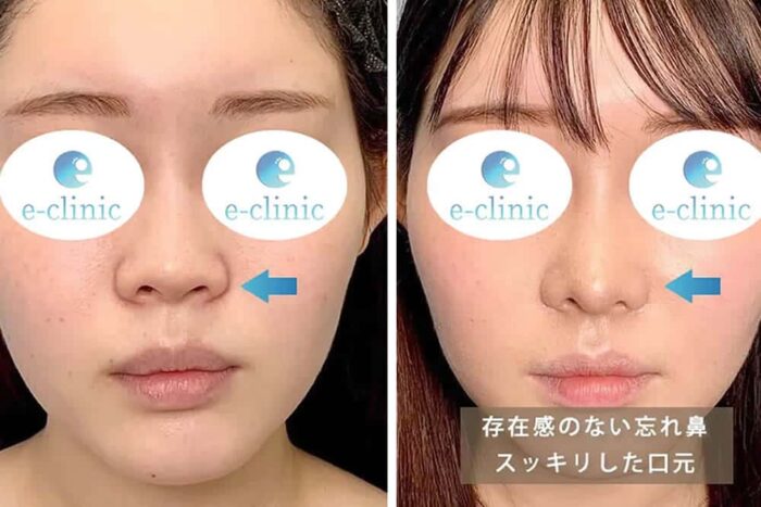 貴族手術の症例写真11