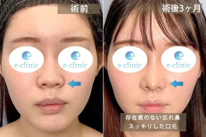 貴族手術の症例写真11