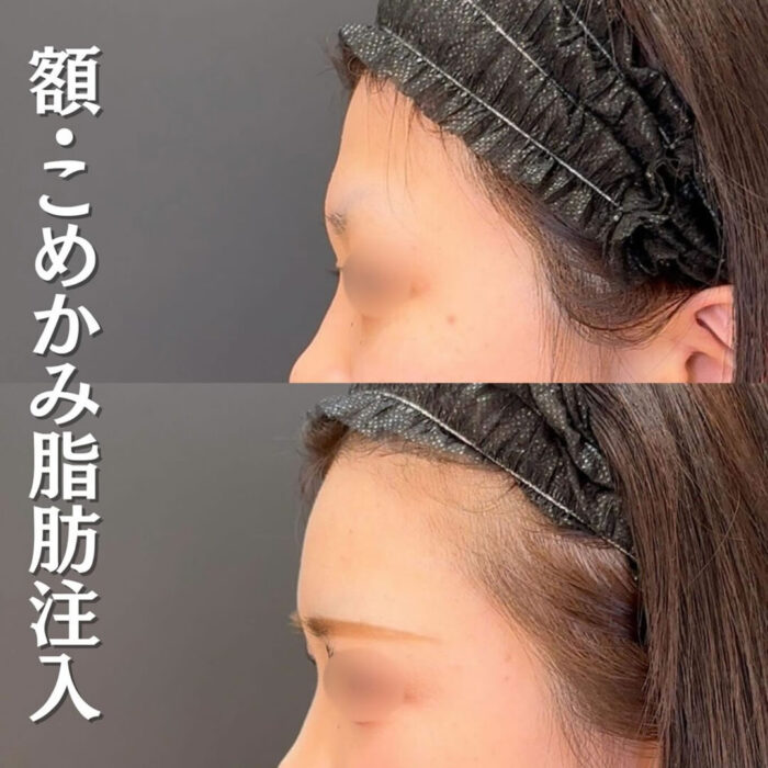 額とこめかみの脂肪注入の症例写真