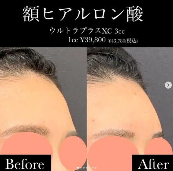 額のヒアルロン酸の症例写真