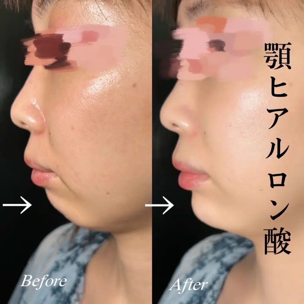 顎のヒアルロン酸の症例写真