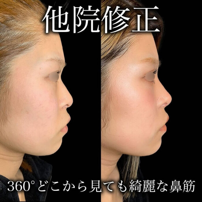 鼻の他院修正で鼻尖形成とプロテーゼを行った症例写真