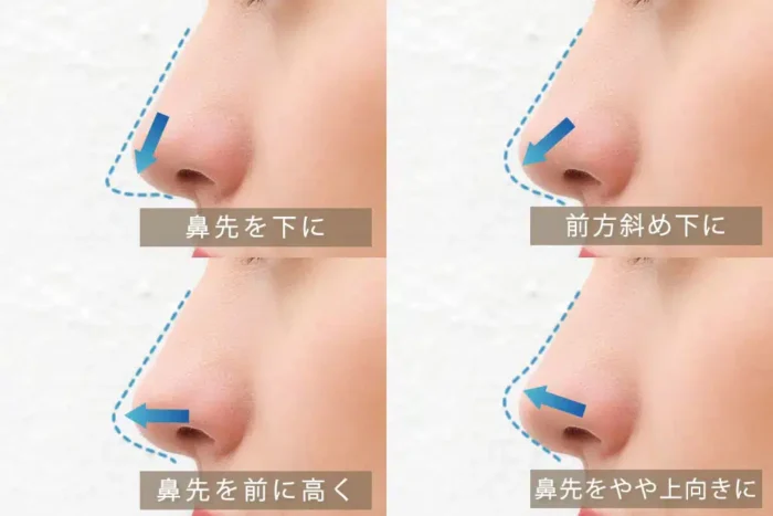 鼻中隔延長のデザイン_図解