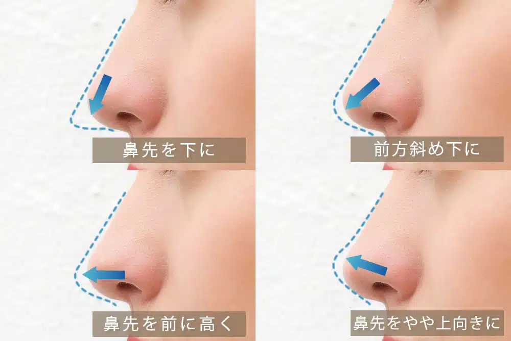 鼻中隔延長のデザイン_図解