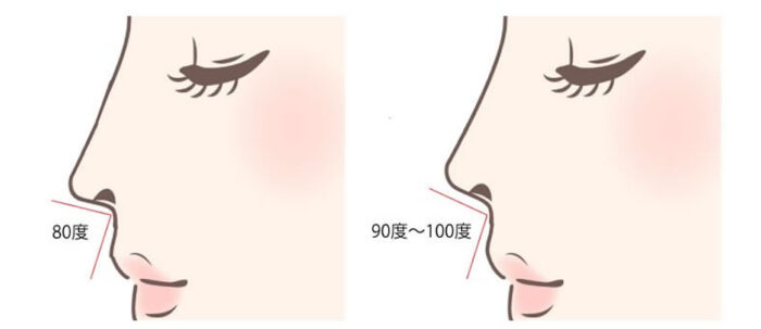 鼻唇角形成術の図解