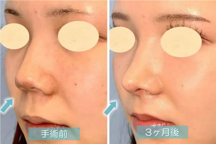 鼻唇角形成術（猫手術）の症例写真