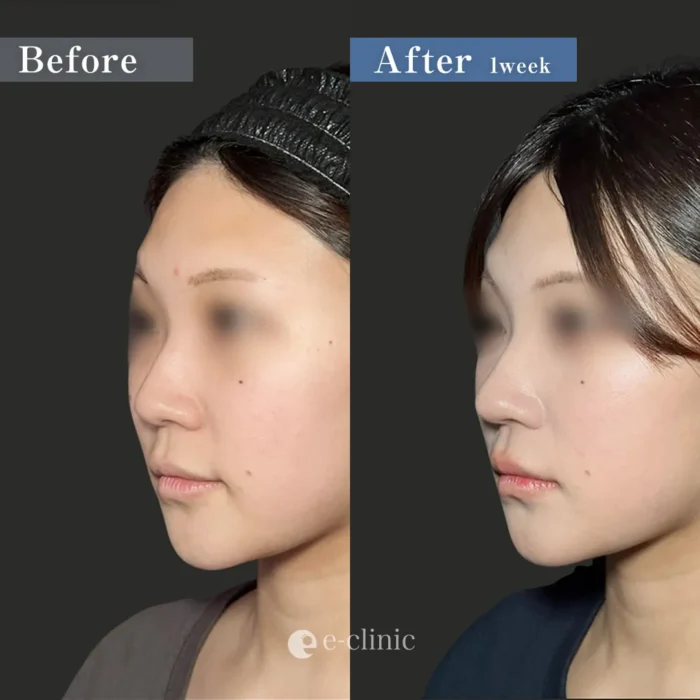 鼻尖形成3D法＋耳介軟骨移植（服部健人）（62）