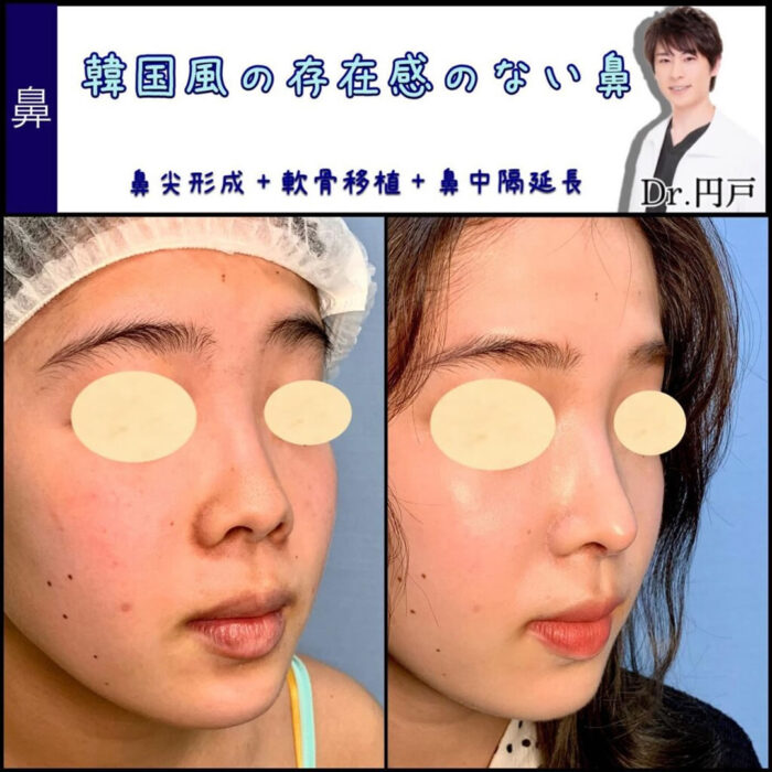 鼻尖形成と軟骨移植と鼻中隔延長の症例写真 (4)
