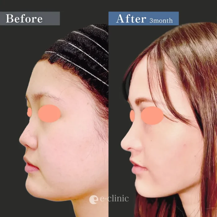 鼻整形_鼻中隔延長＋軟骨移植＋鼻尖形成3D法＋頬顎脂肪吸引（円戸望）（172）