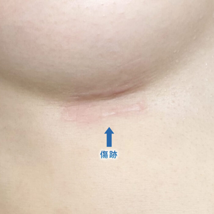 ６ヶ月後の肋軟骨の傷跡